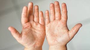 Anfangsstadium Mundbereich Mund Hand Fuß Krankheit Anfang – Erste Symptome im Mund erkennen und richtig reagieren anfangsstadium mundbereich mund hand fuß krankheit anfang