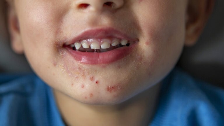 Gesicht Anfangsstadium Hand Fuß Mund Krankheit leichte Form – Symptome, Bilder, Verlauf & Faktencheck 2026 gesicht anfangsstadium hand fuß mund krankheit leichte form